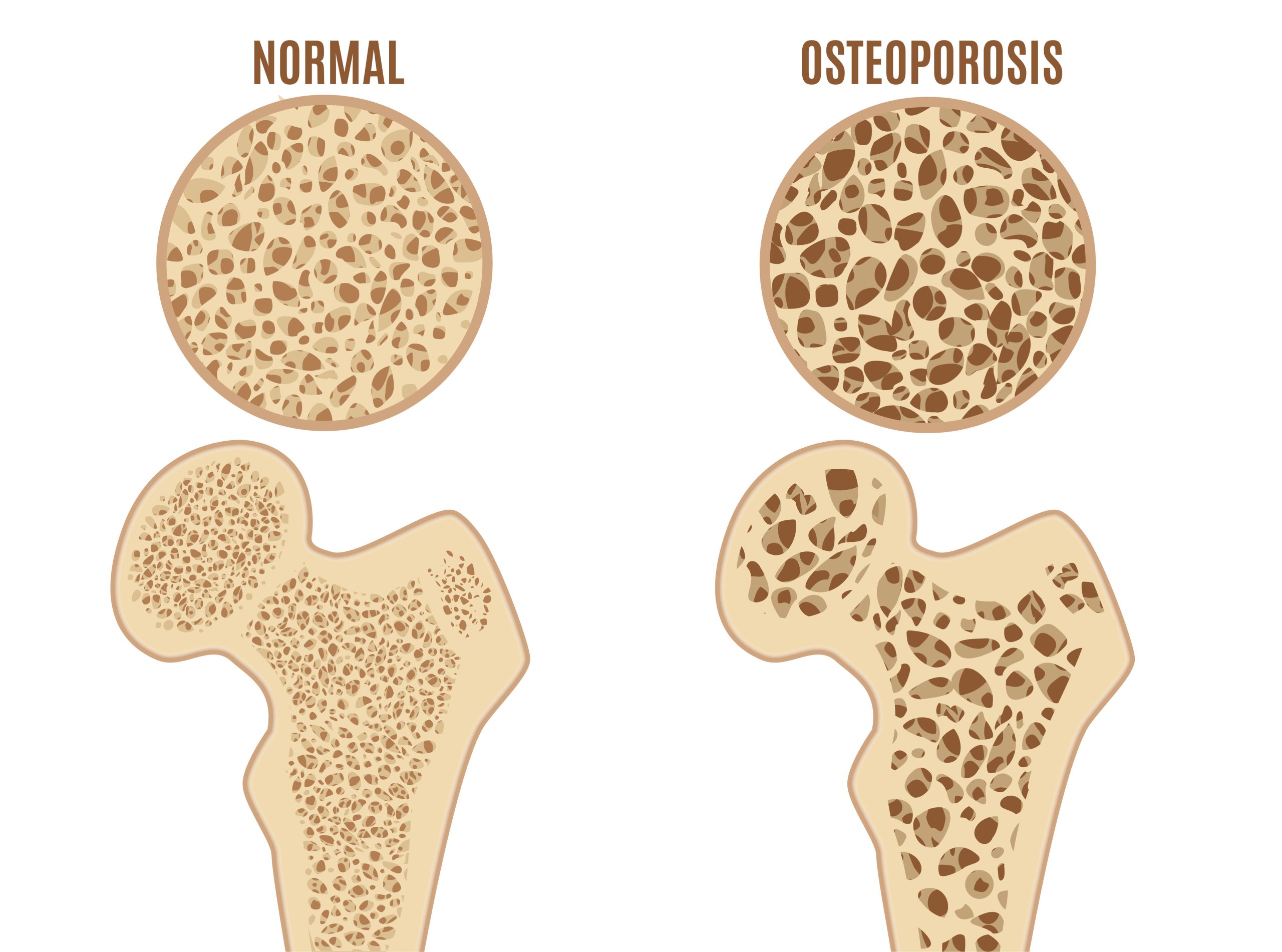 Knochengesundheit und Osteoporose
