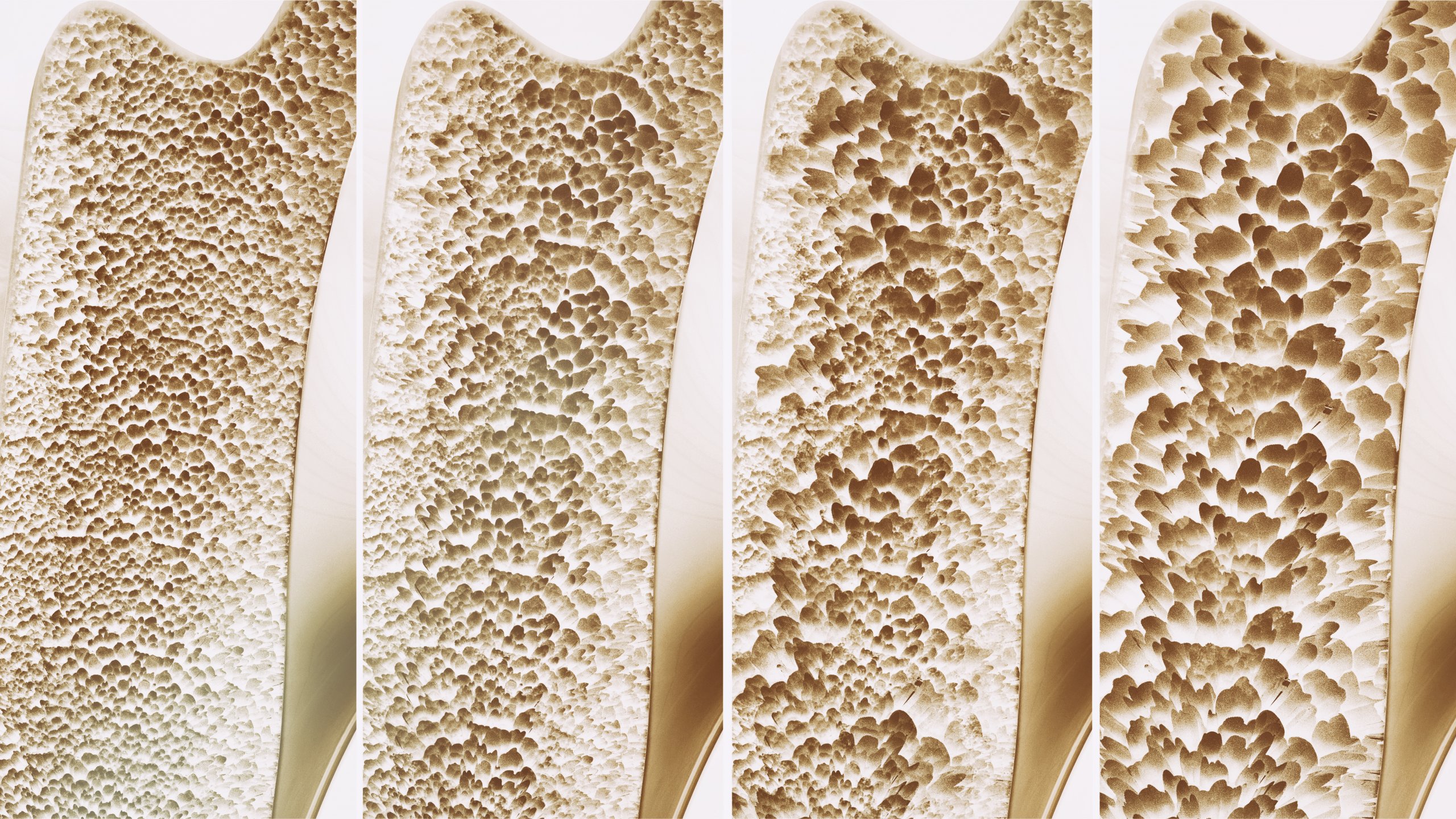 Volkskrankheit Osteoporose